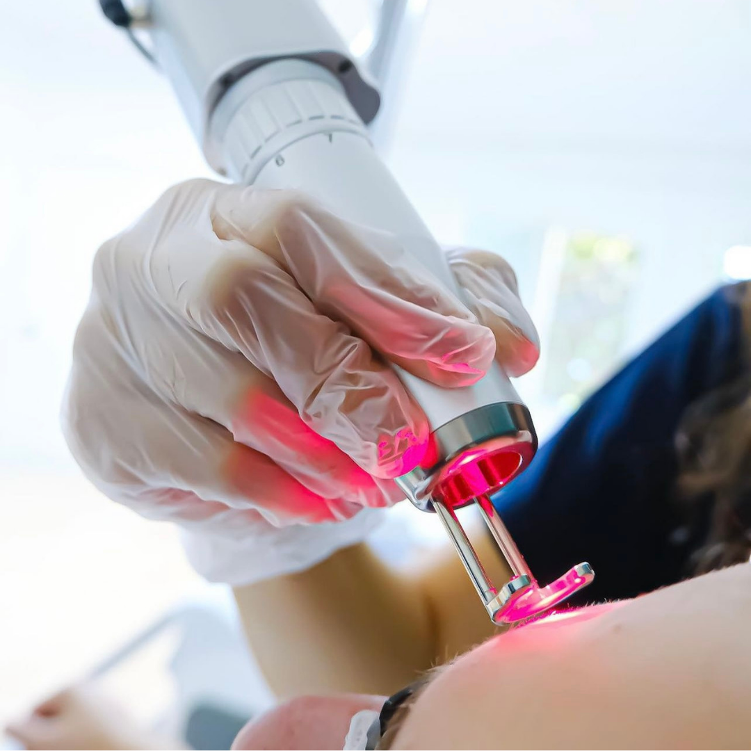 Q-Switched ND YAG Laser Treatment Process